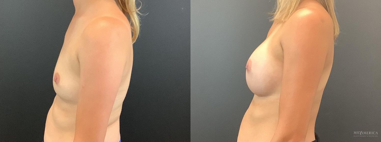Breast Augmentation Before & After