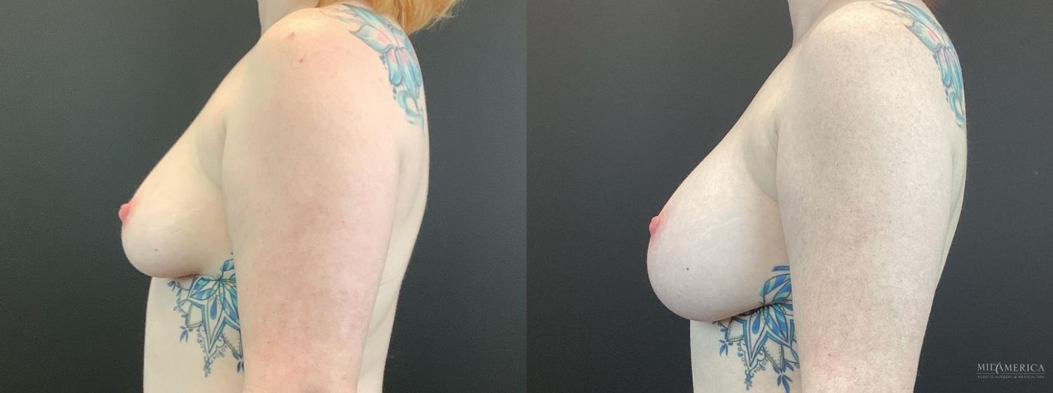 Breast Augmentation Before & After