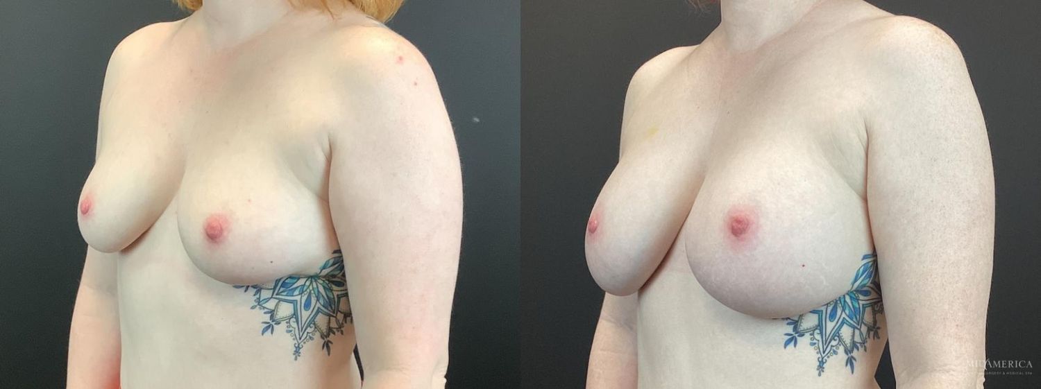 Breast Augmentation Before & After
