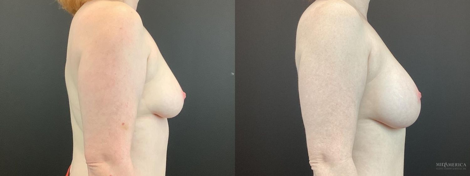 Breast Augmentation Before & After