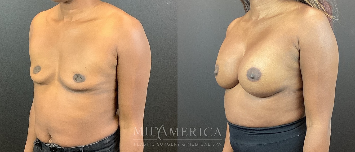 Breast Augmentation Before & After