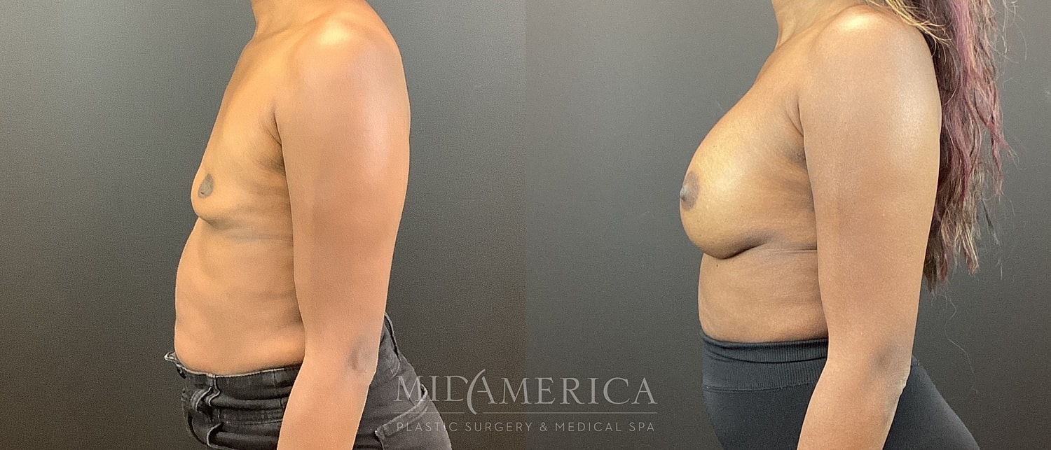 Breast Augmentation Before & After