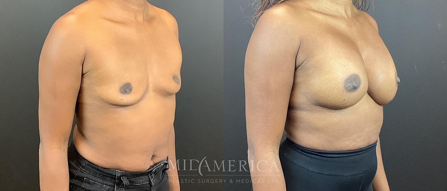 Breast Augmentation Before & After