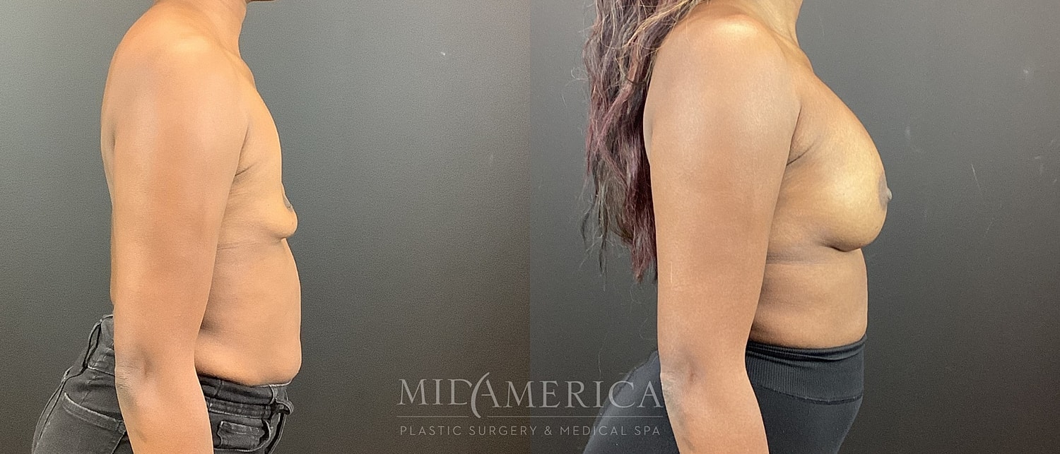 Breast Augmentation Before & After