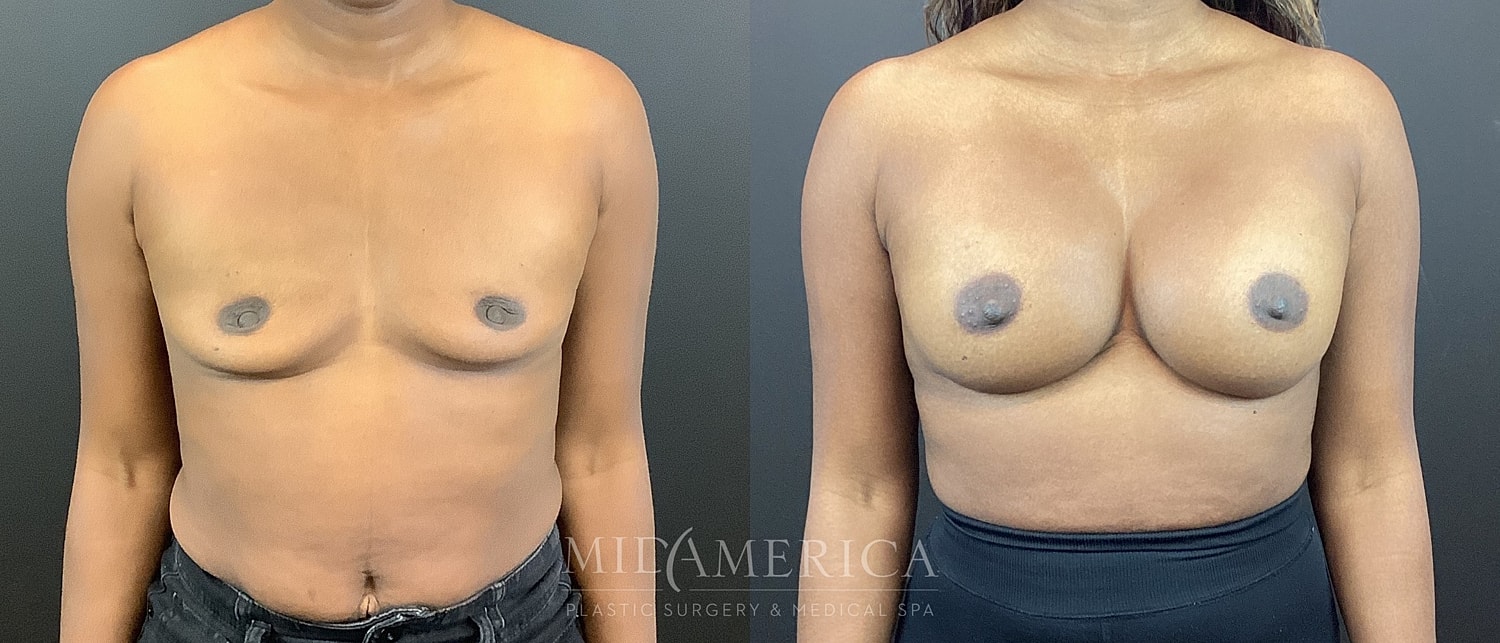 Breast Augmentation Before & After