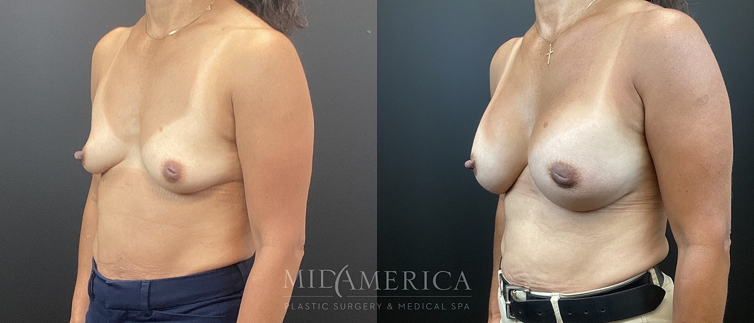 Breast Augmentation Before & After