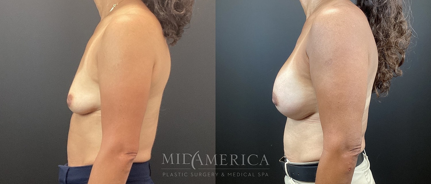 Breast Augmentation Before & After