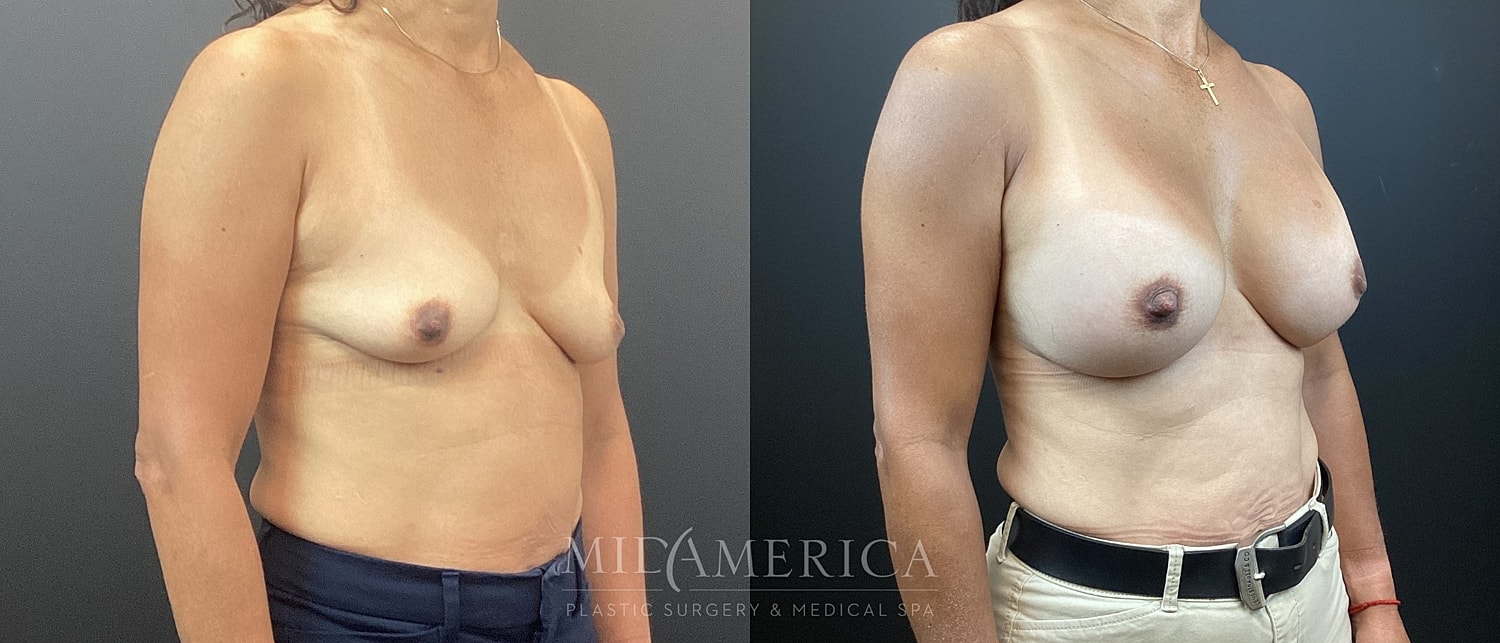 Breast Augmentation Before & After