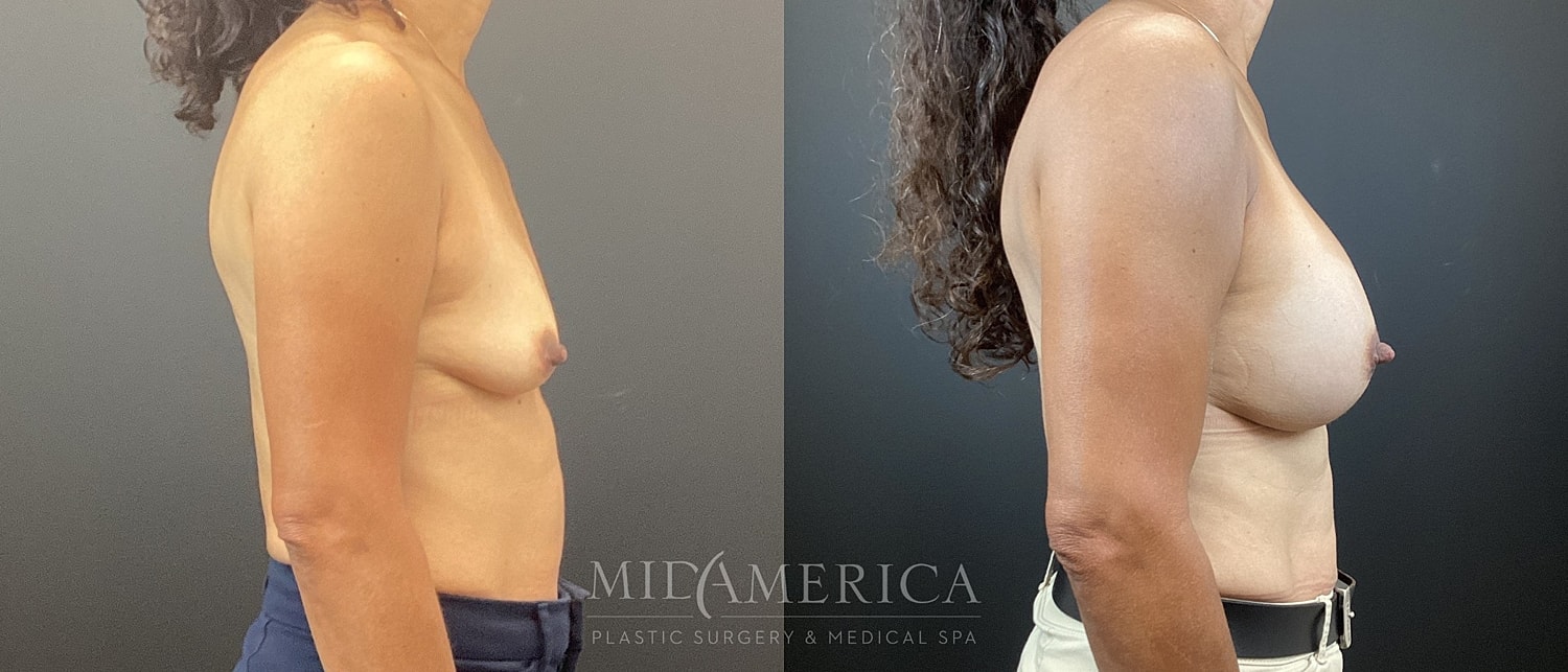 Breast Augmentation Before & After