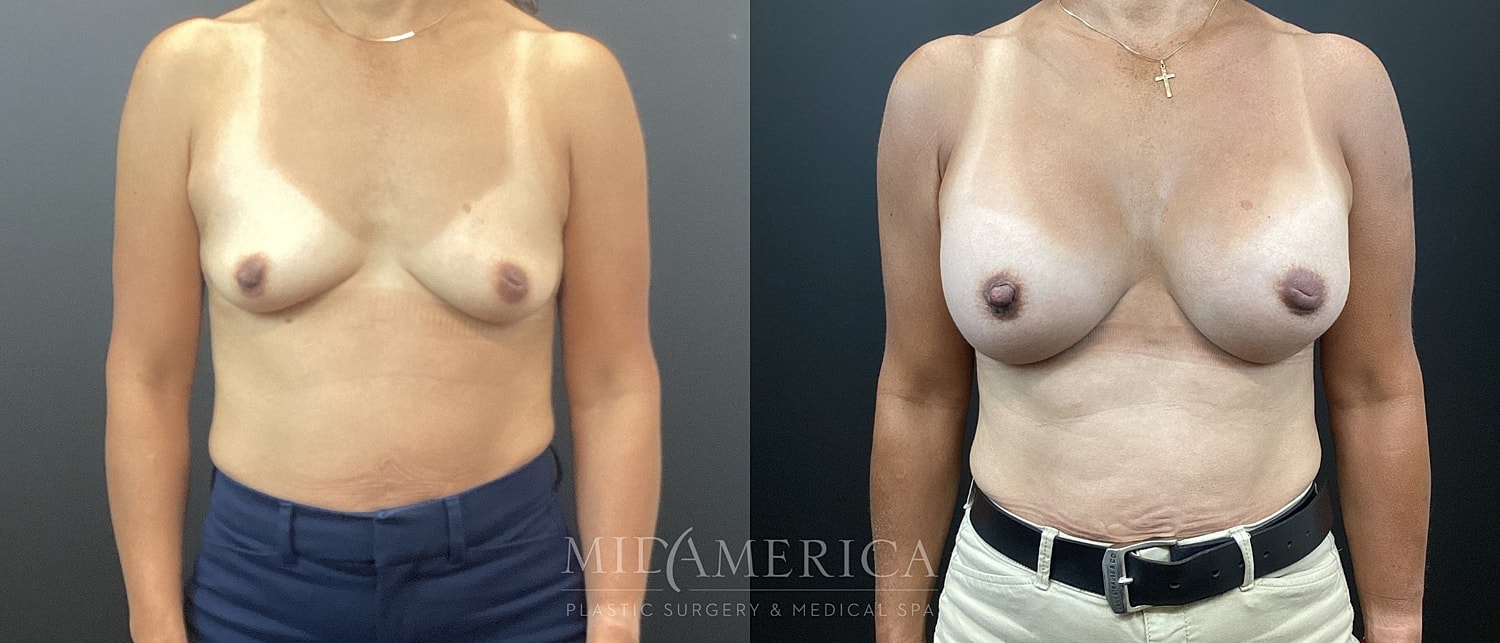 Breast Augmentation Before & After