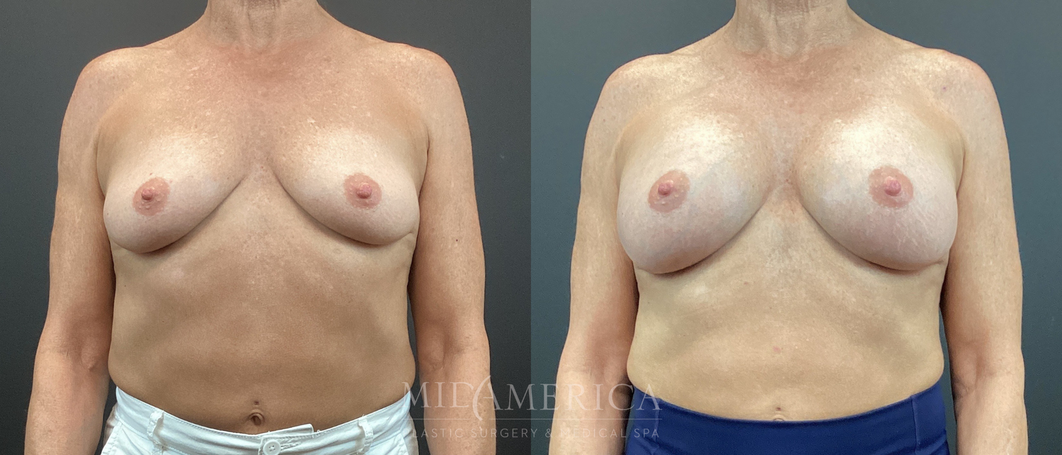 Breast Augmentation Before & After