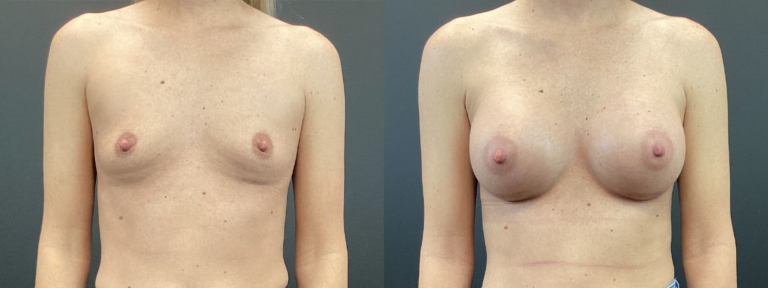 Breast Augmentation Before & After