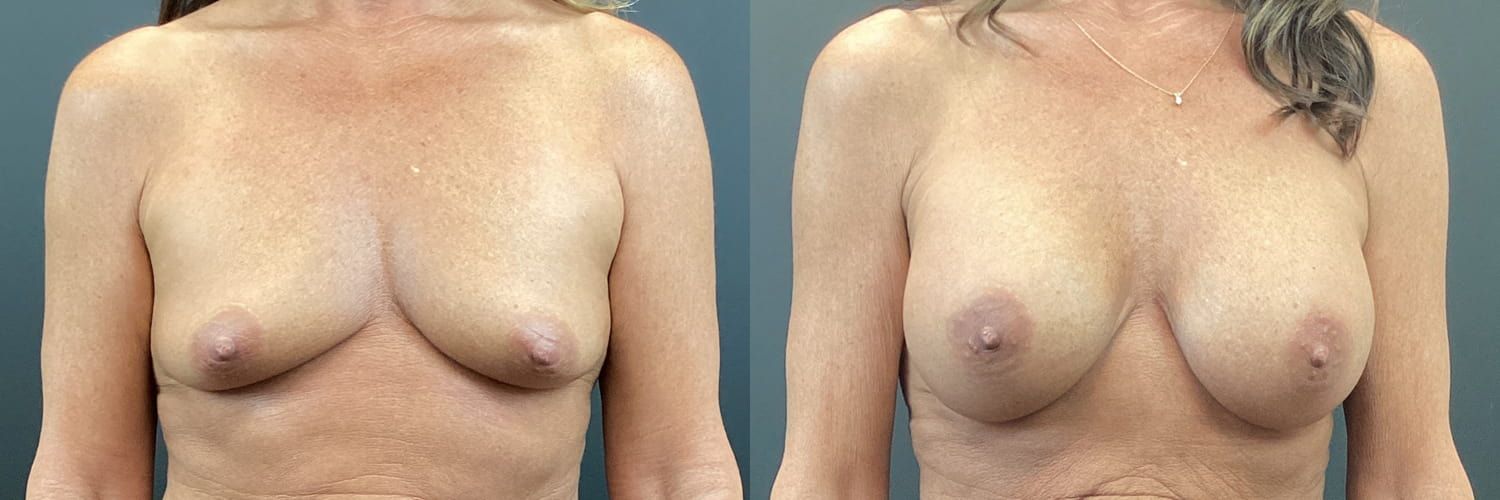 Breast Augmentation Before & After