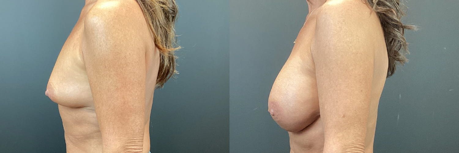 Breast Augmentation Before & After