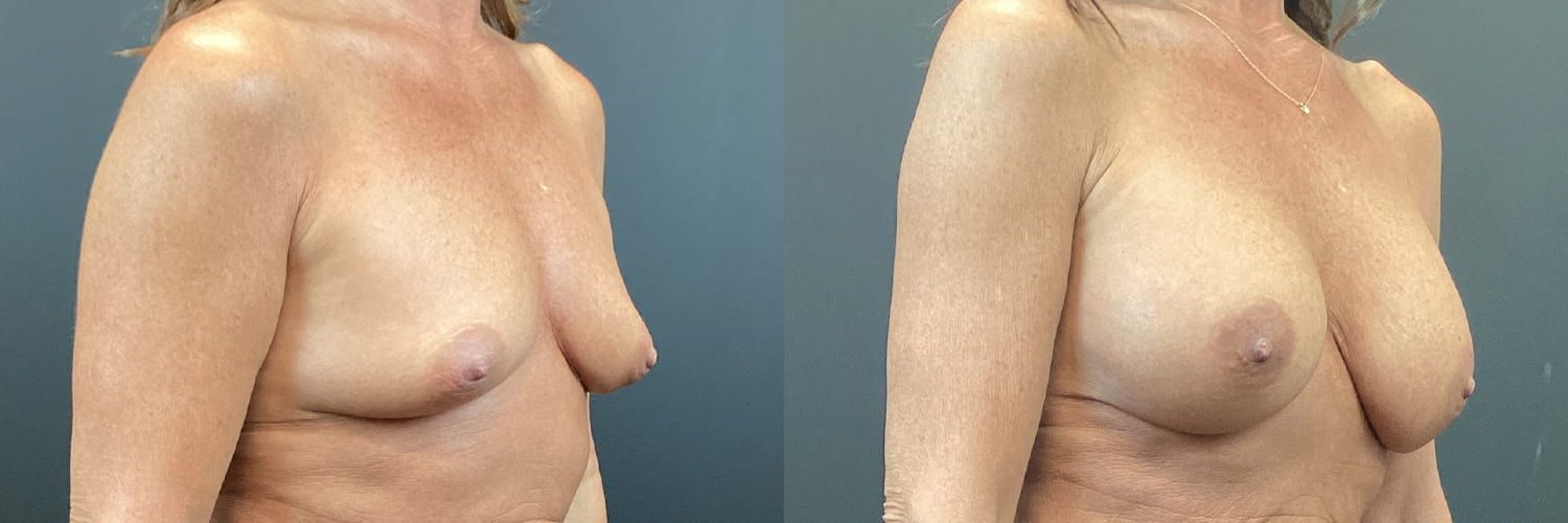 Breast Augmentation Before & After