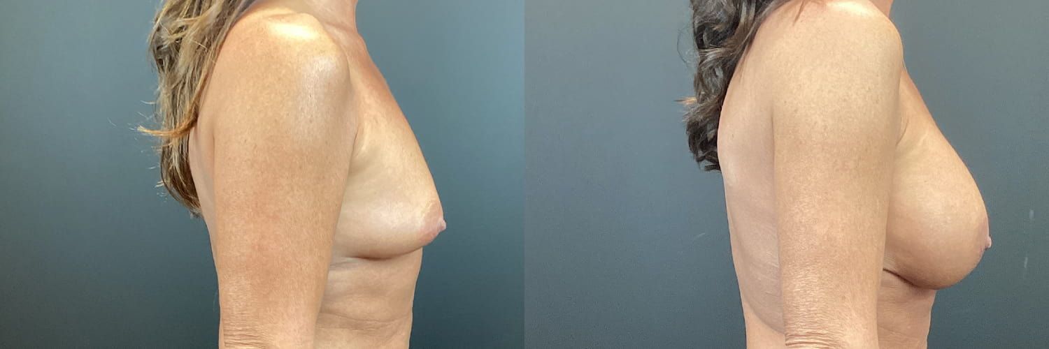 Breast Augmentation Before & After