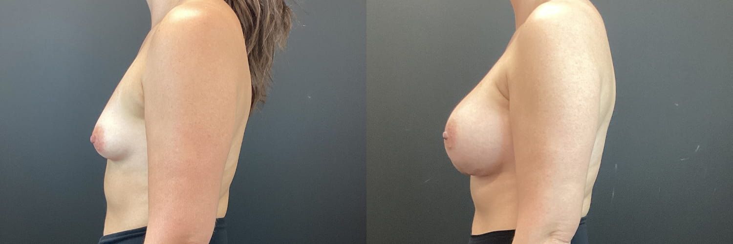 Breast Augmentation Before & After