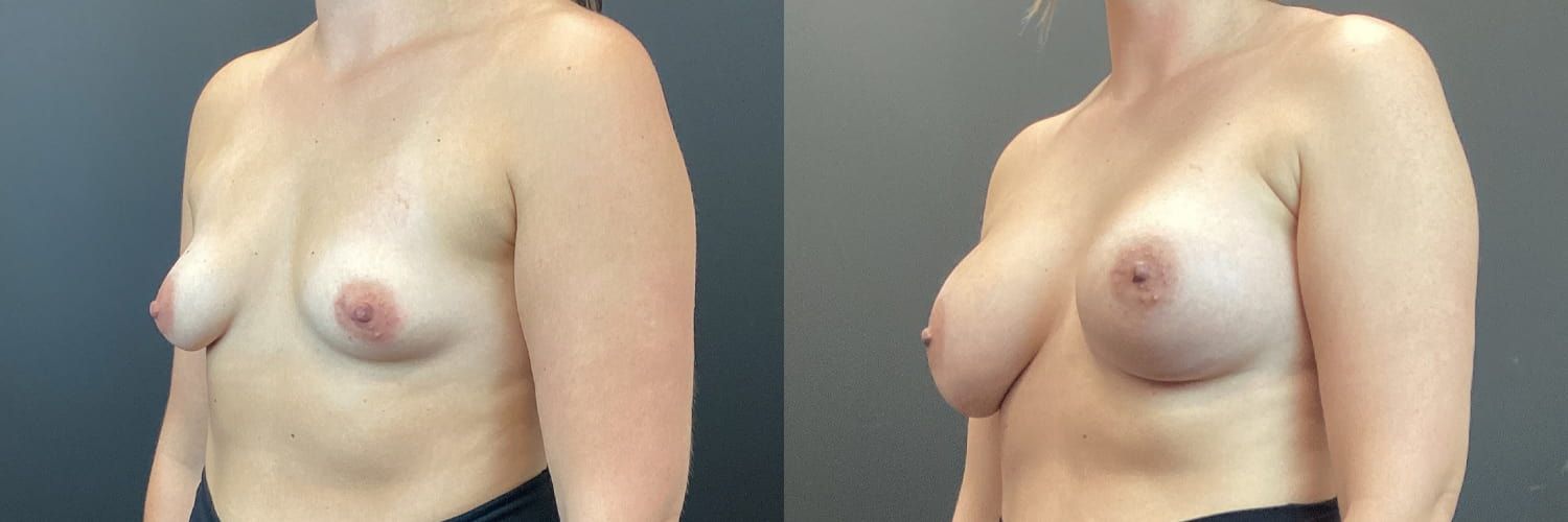 Breast Augmentation Before & After
