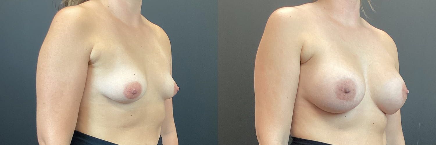 Breast Augmentation Before & After