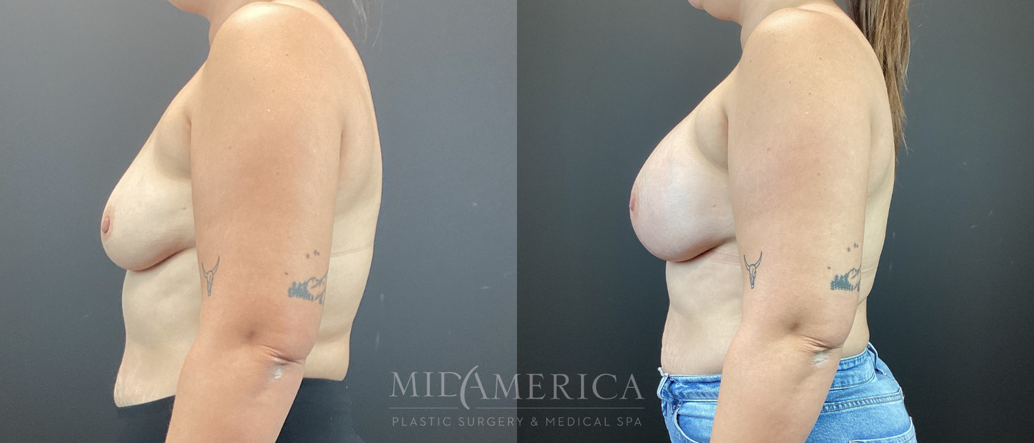 Breast Augmentation Before & After