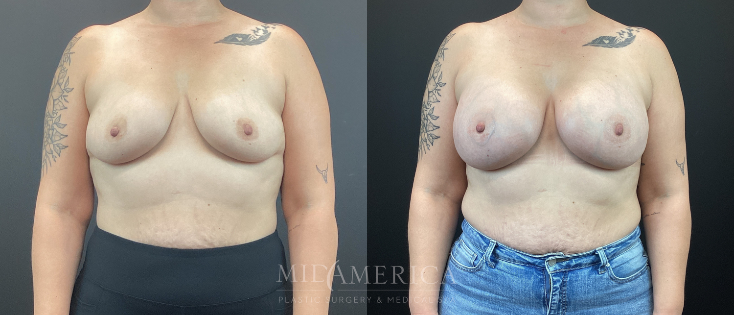 Breast Augmentation Before & After