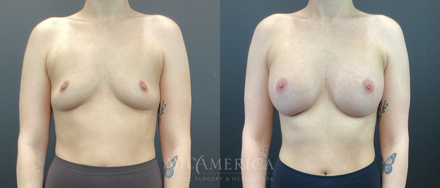 Breast Augmentation Before & After
