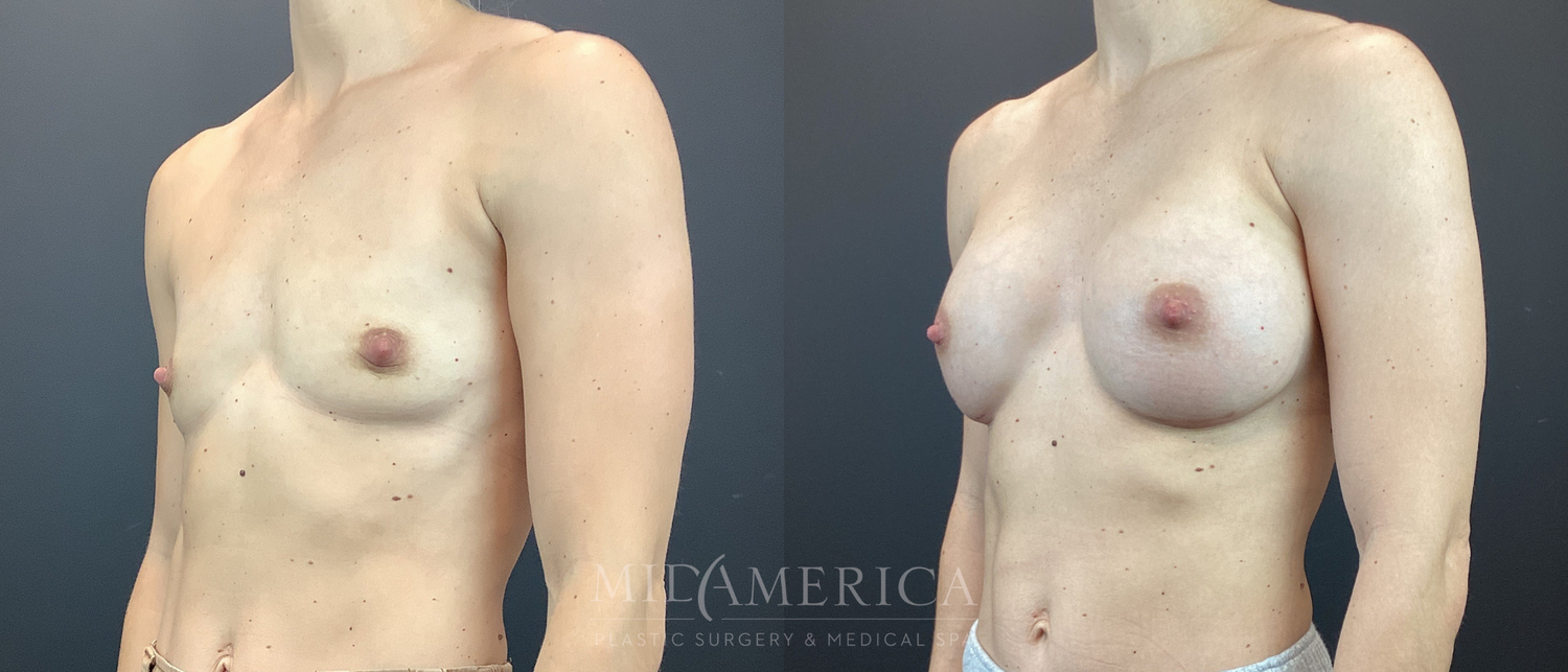 Breast Augmentation Before & After