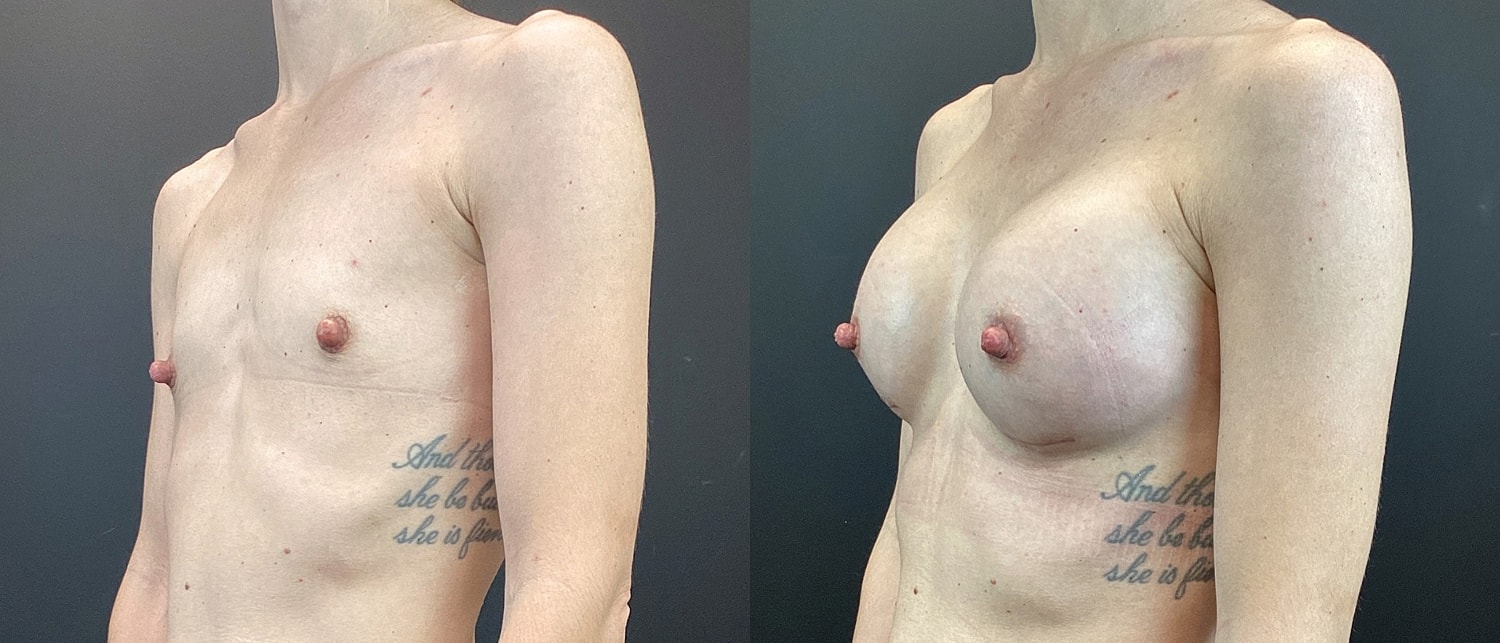 Breast Augmentation Before & After