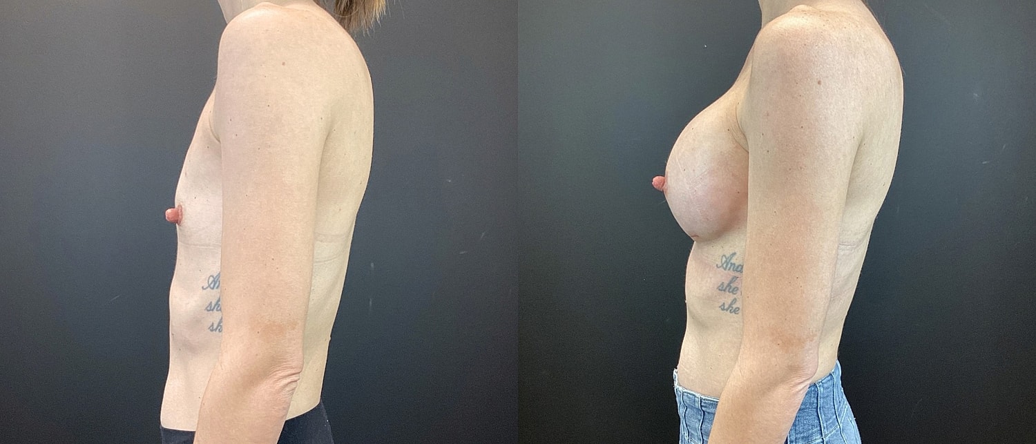 Breast Augmentation Before & After