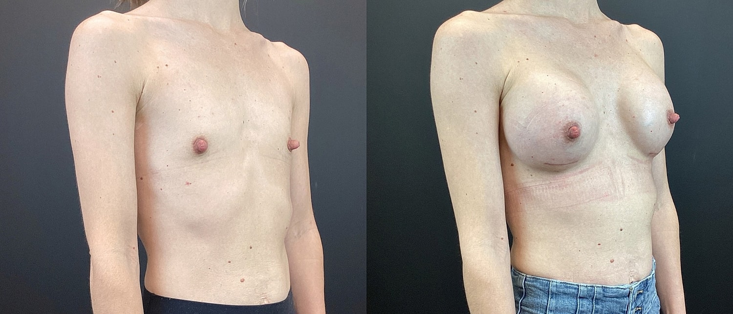 Breast Augmentation Before & After
