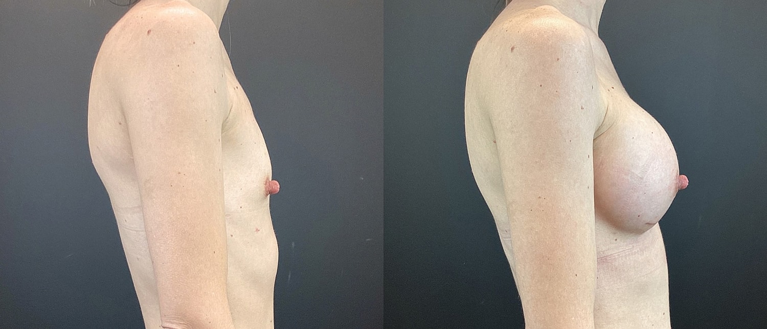 Breast Augmentation Before & After