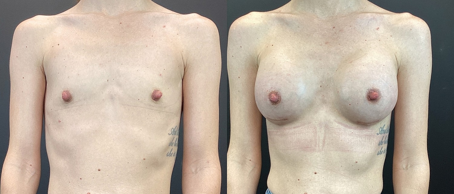 Breast Augmentation Before & After