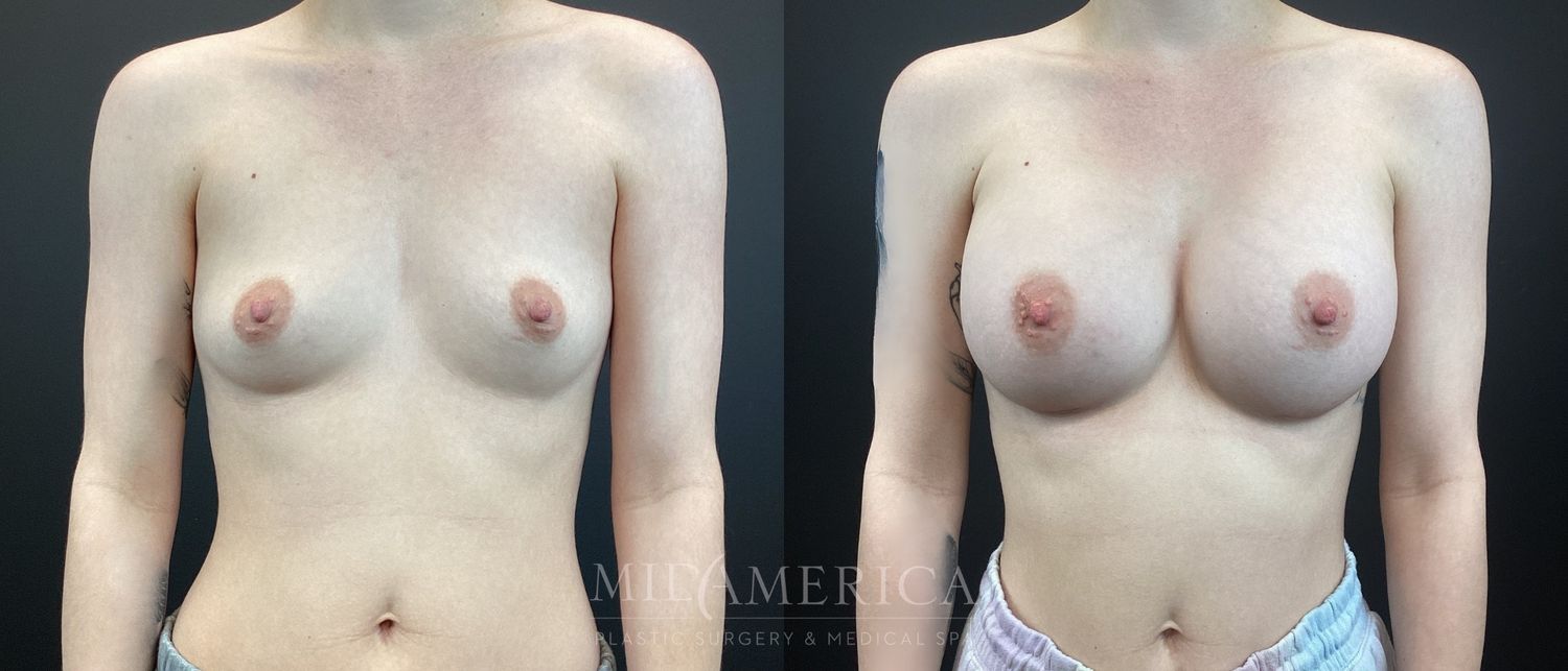 Breast Augmentation Before & After