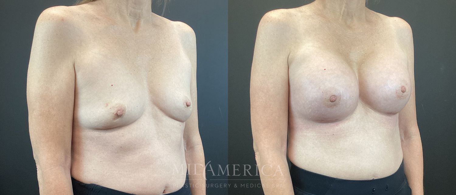 Breast Augmentation Before & After