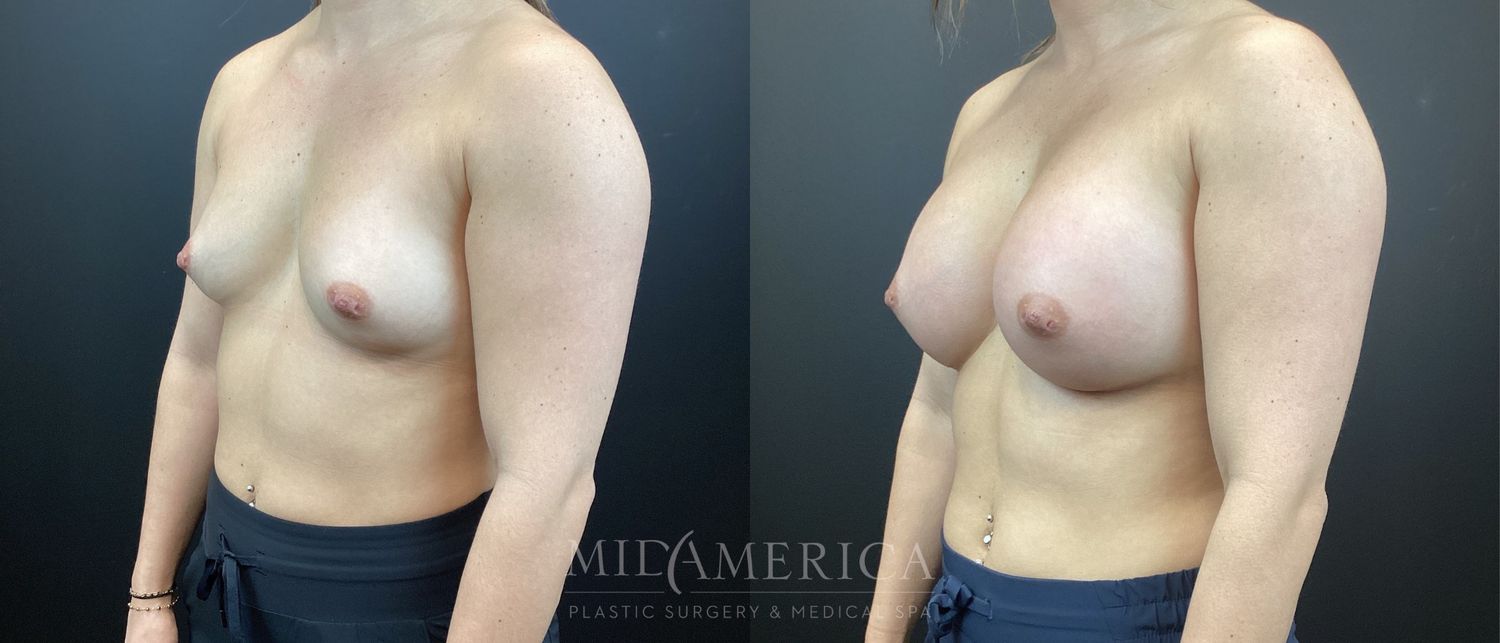 Breast Augmentation Before & After