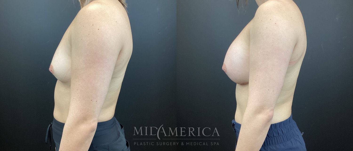 Breast Augmentation Before & After