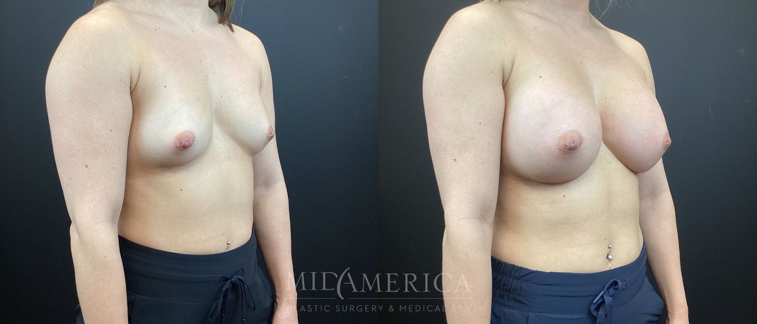 Breast Augmentation Before & After