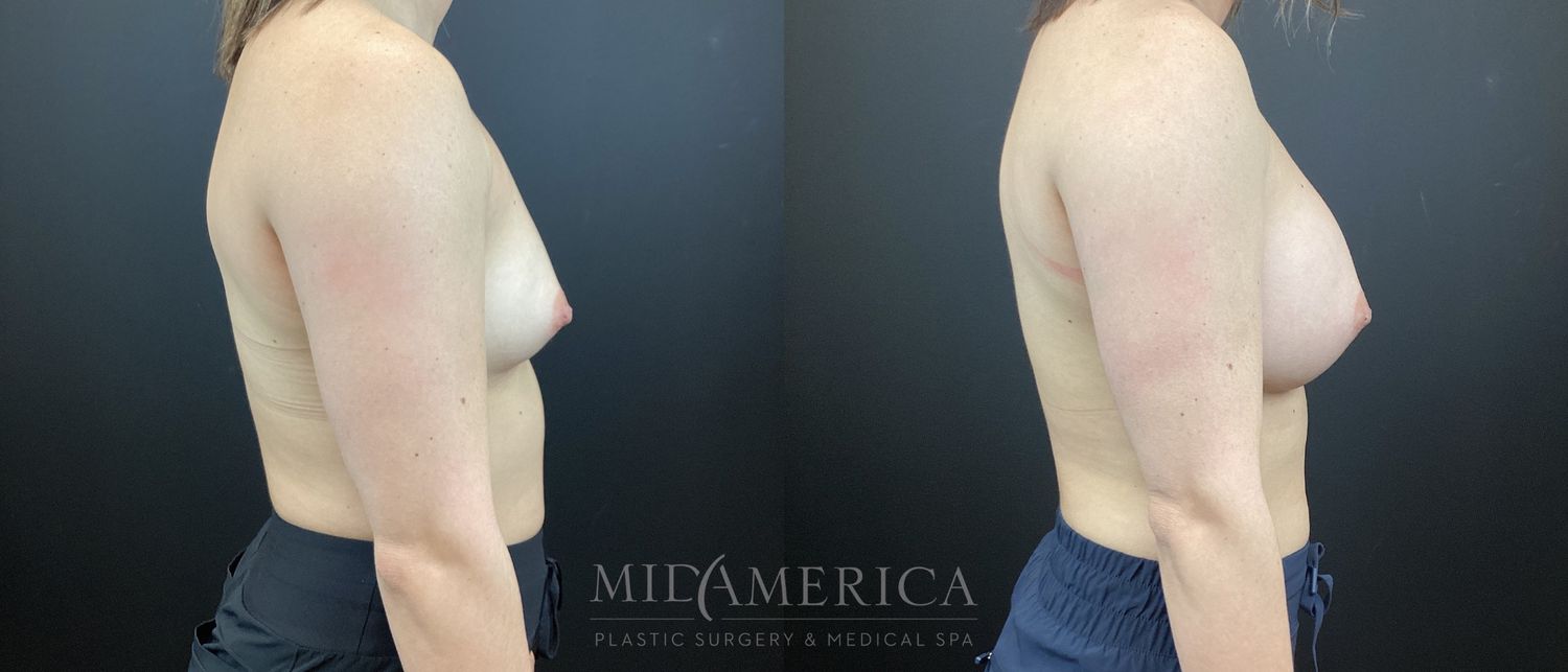 Breast Augmentation Before & After