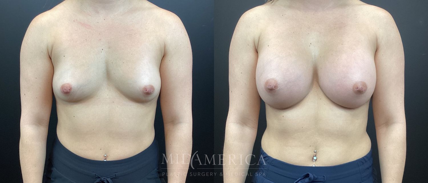 Breast Augmentation Before & After