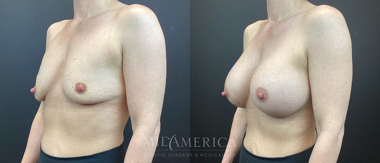 Breast Augmentation Before & After