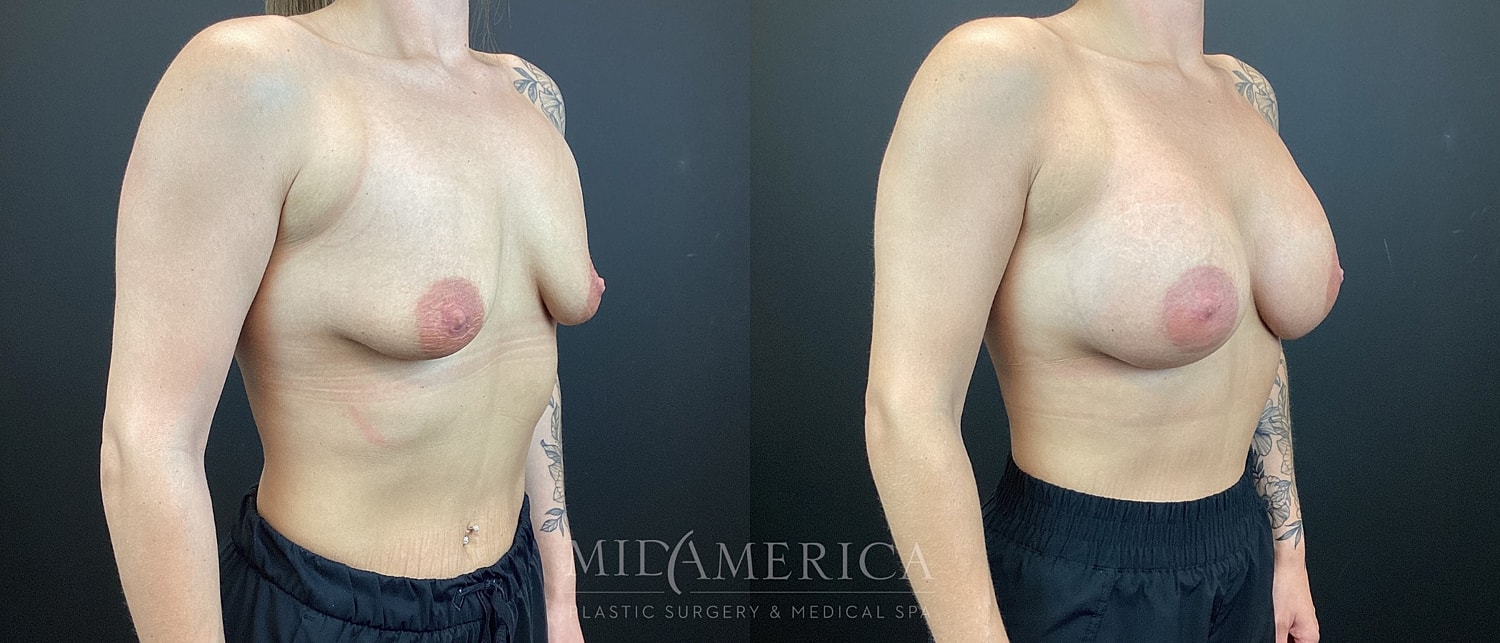 Breast Augmentation Before & After