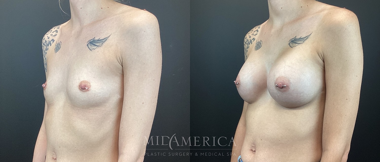 Breast Augmentation Before & After