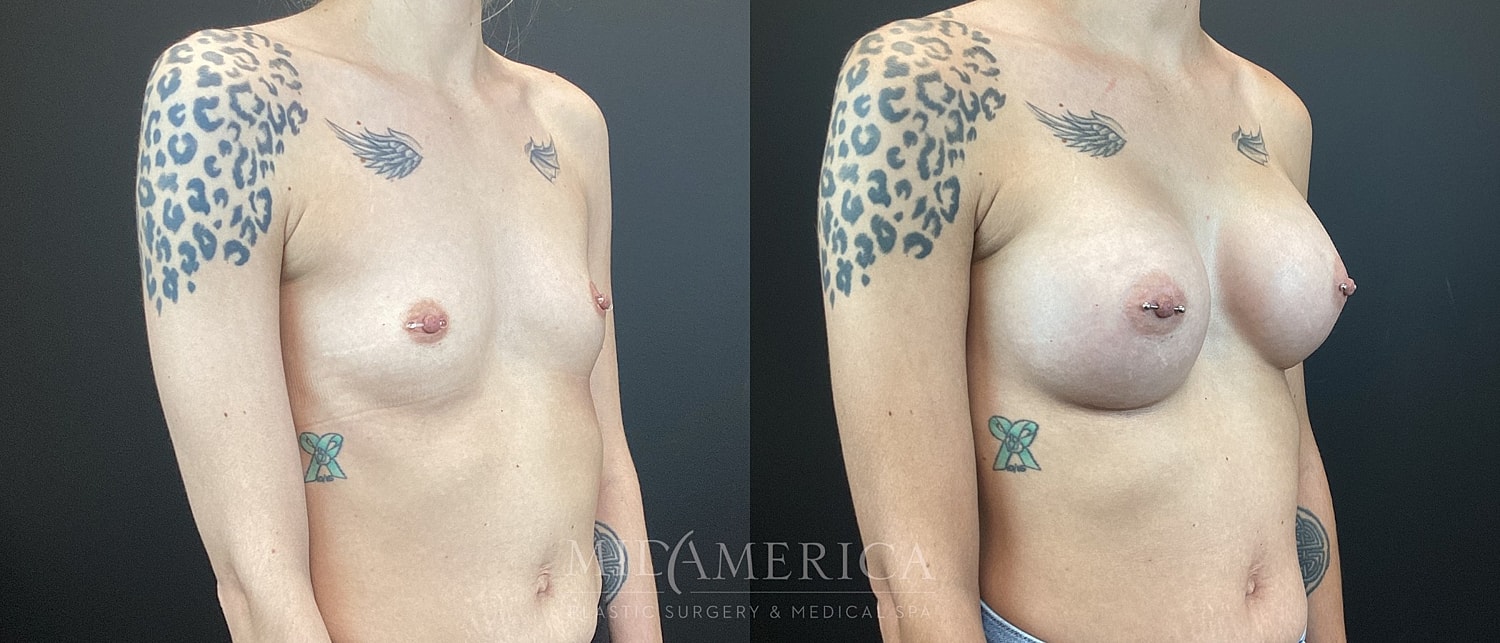 Breast Augmentation Before & After