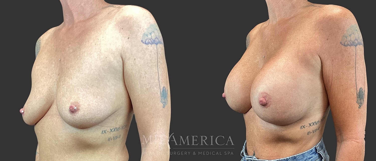 Breast Augmentation Before & After