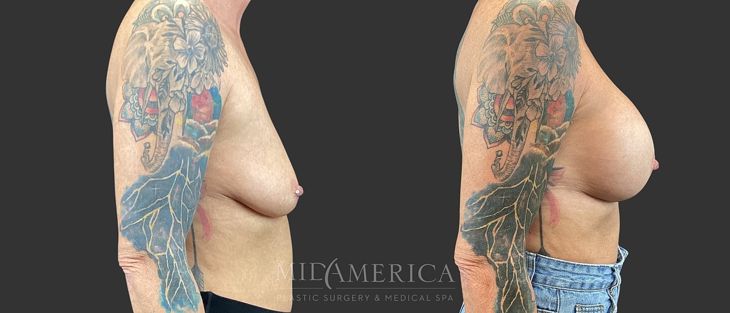 Breast Augmentation Before & After