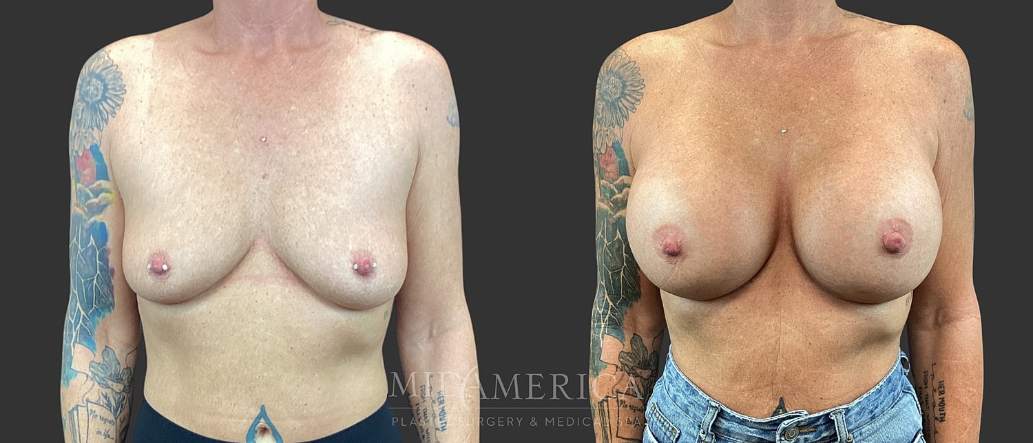 Breast Augmentation Before & After