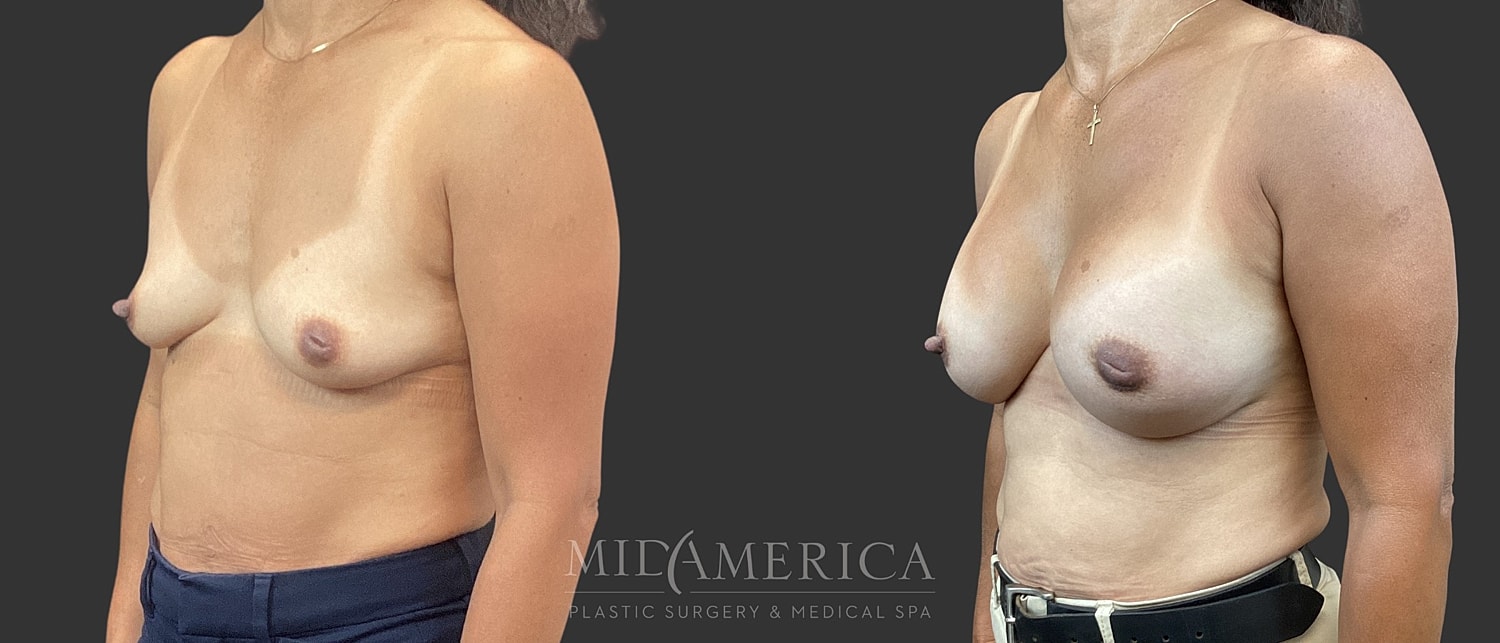 Breast Augmentation Before & After