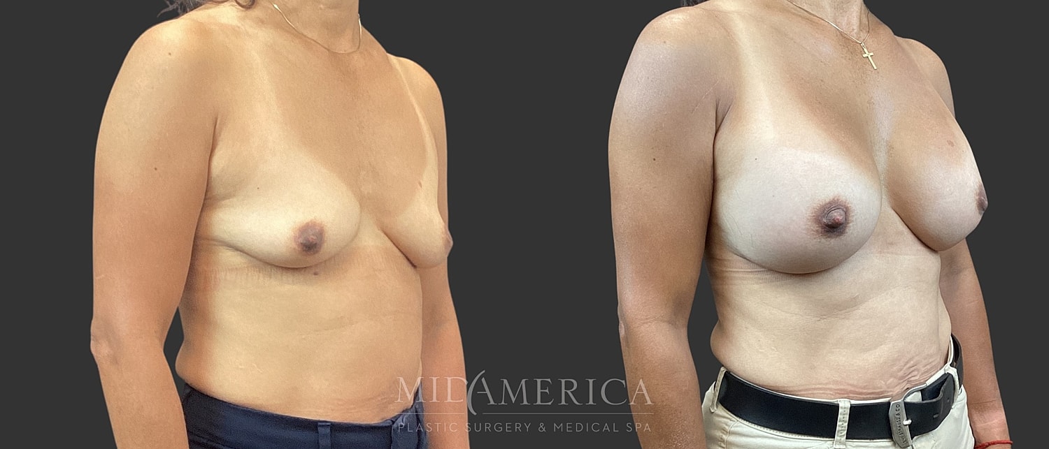 Breast Augmentation Before & After