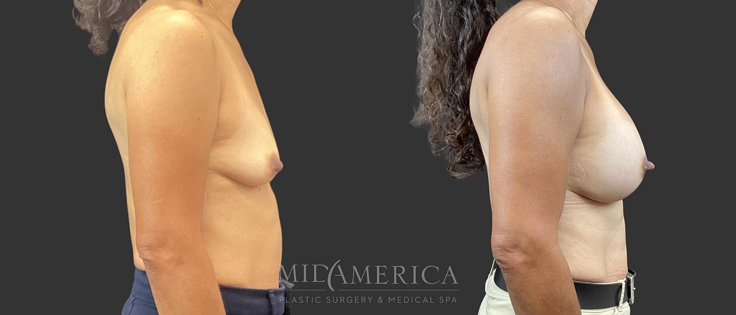 Breast Augmentation Before & After