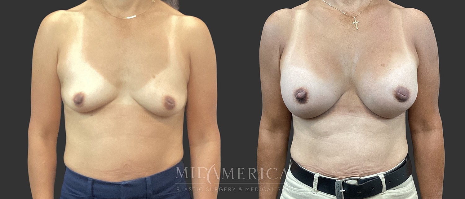Breast Augmentation Before & After